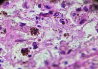 Los genes heredados juegan un papel más importante en el riesgo de melanoma de lo que se creía anteriormente