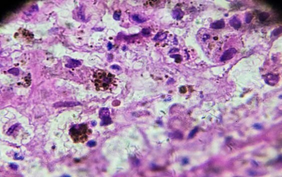 Los genes heredados juegan un papel más importante en el riesgo de melanoma de lo que se creía anteriormente